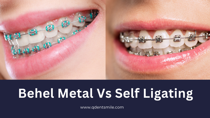 behel gigi metal konvensional dan behel self ligating