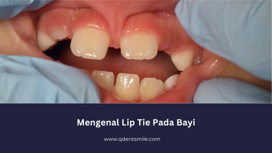 Mengenal Lip Tie Pada Bayi