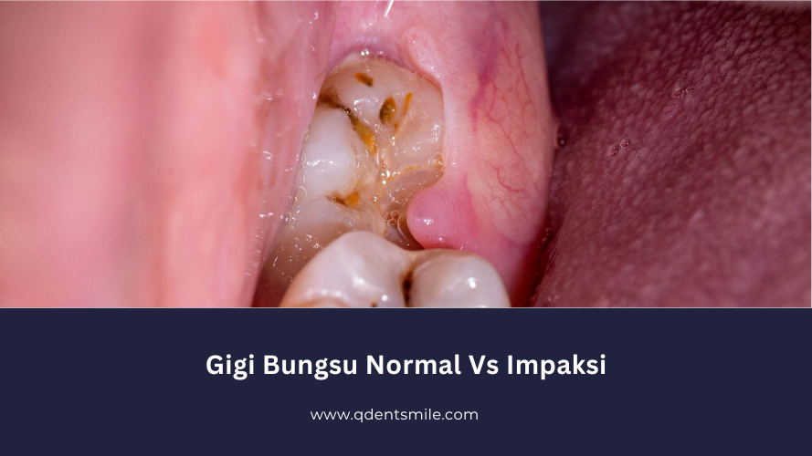 Gigi Bungsu Normal Vs Impaksi