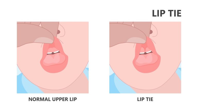Lip Tie Pada Bayi