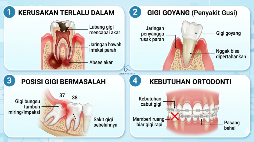 Kapan Sih Gigi Sebenarnya Harus Dicabut?