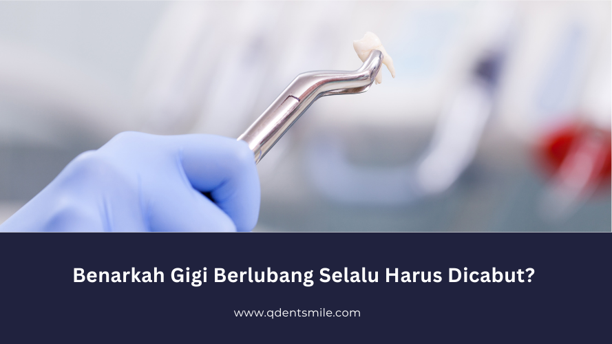 Benarkah Gigi Berlubang Selalu Harus Dicabut?