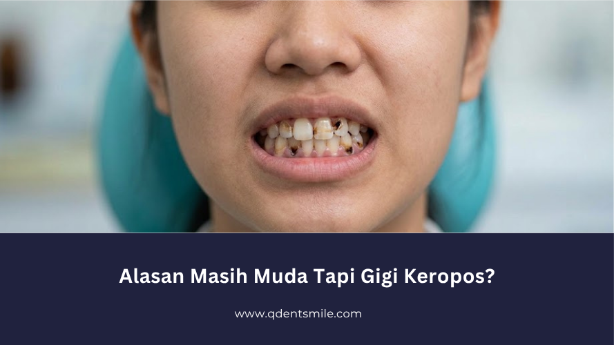 Alasan Masih Muda Tapi Gigi Keropos?