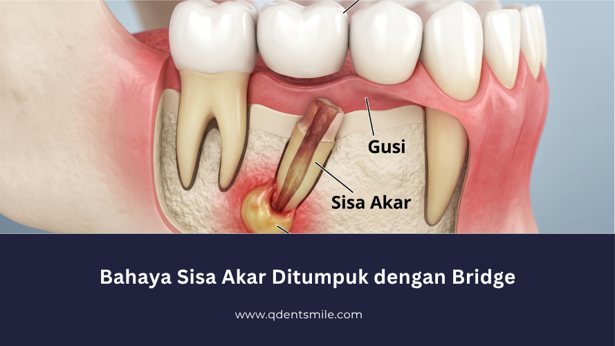 Bahaya Sisa Akar Ditumpuk dengan Bridge!
